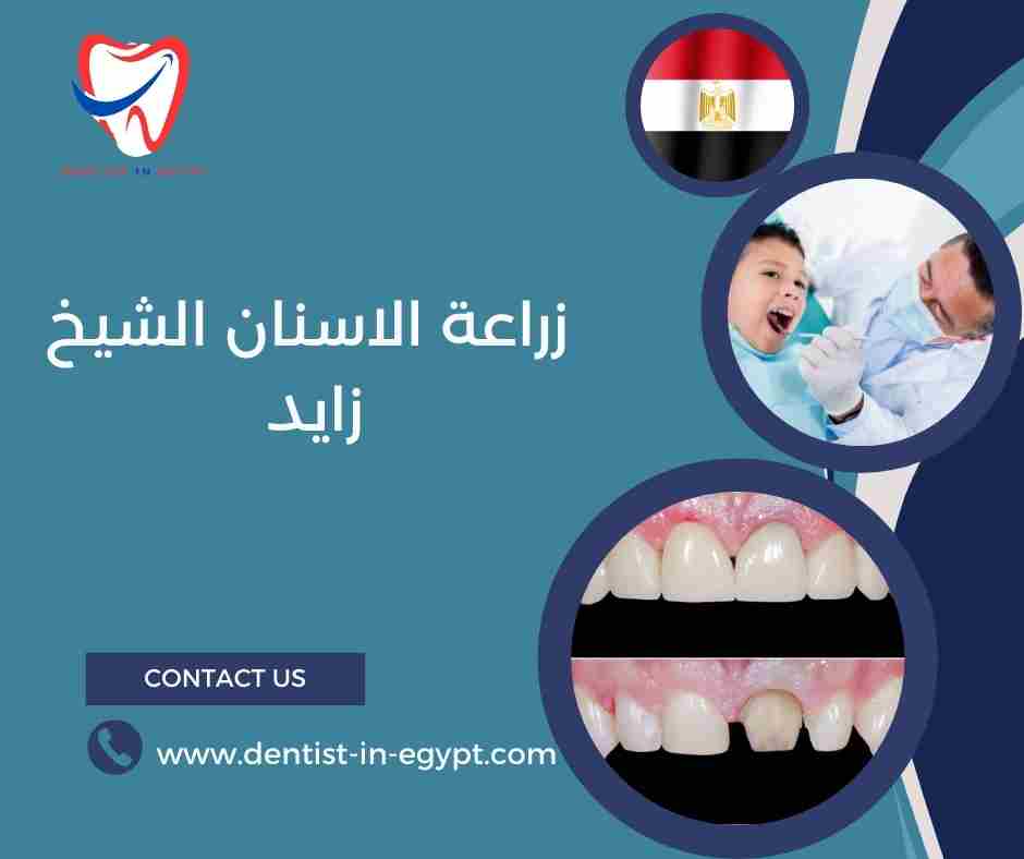 زراعة الاسنان الشيخ زايد
