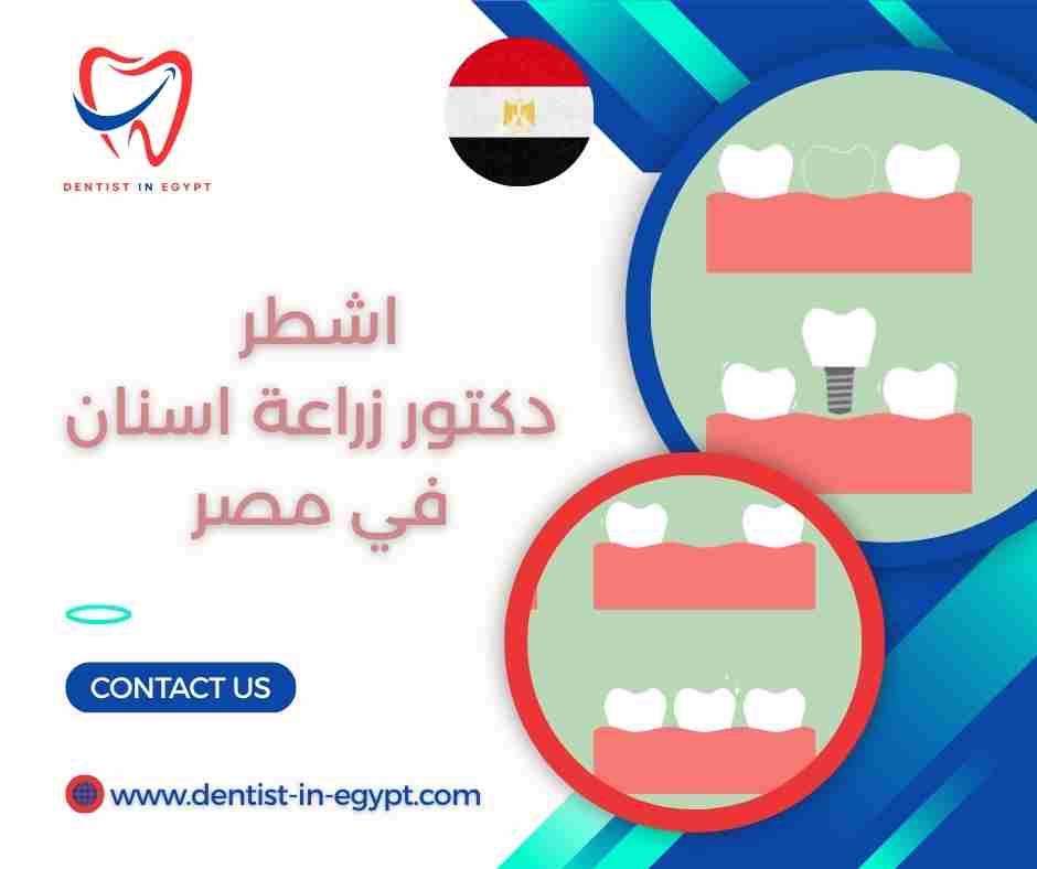اشطر دكتور زراعة اسنان في مصر
