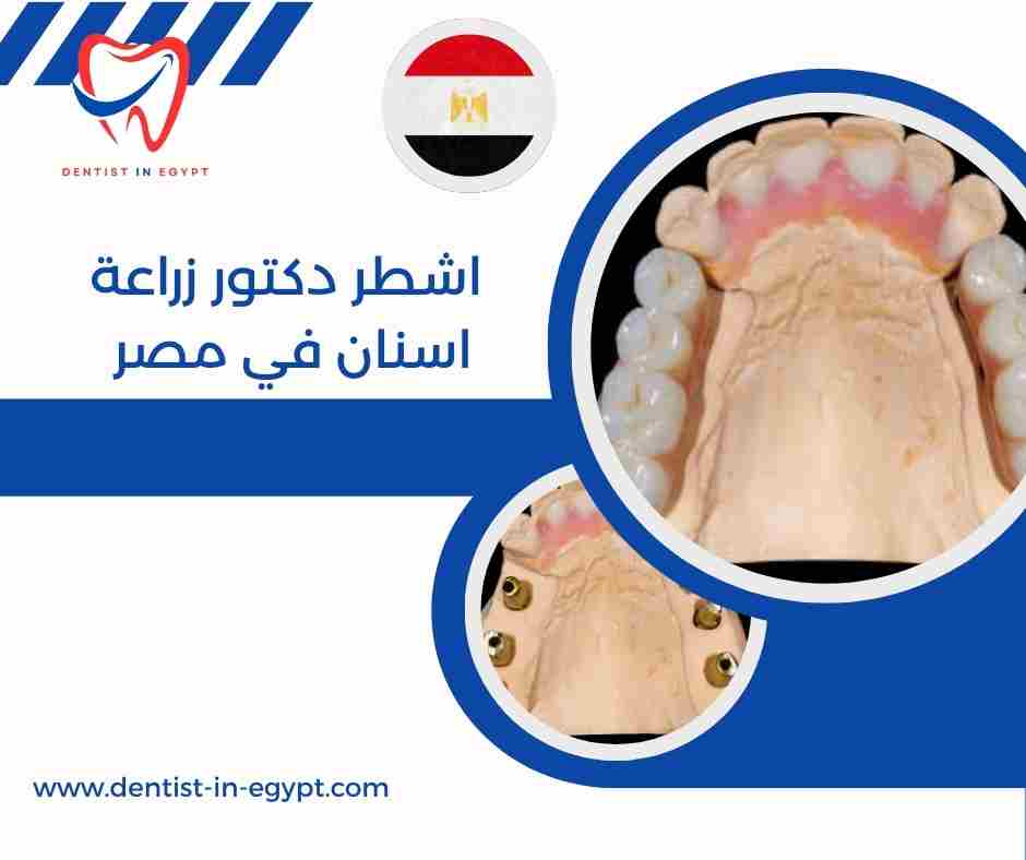 اشطر دكتور زراعة اسنان في مصر