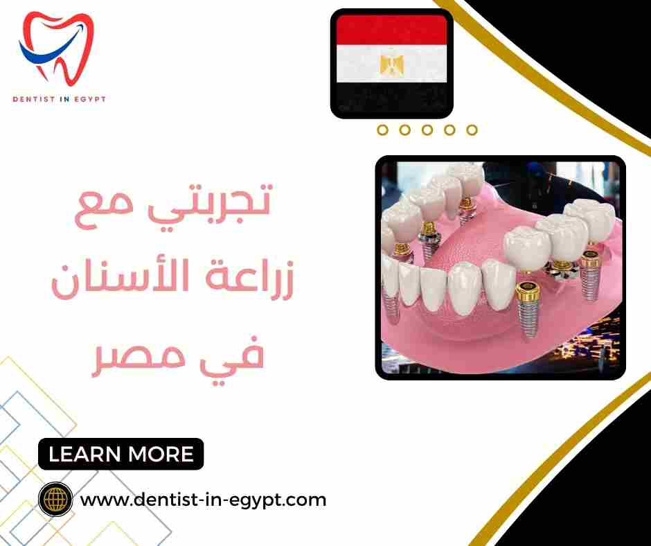 تجربتي مع زراعة الأسنان في مصر