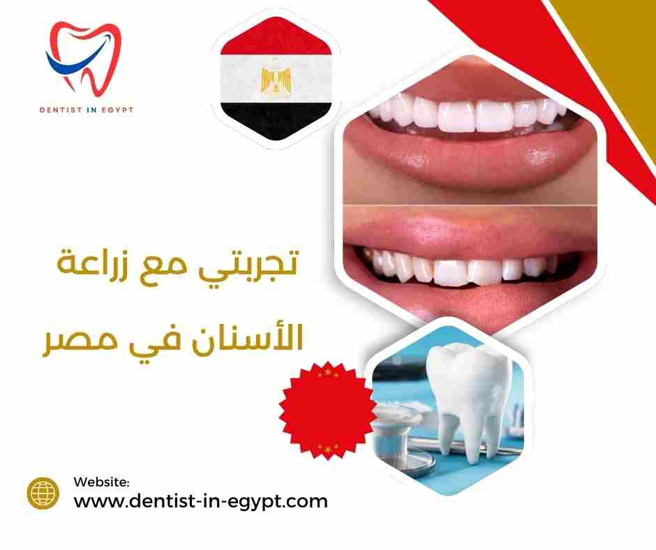 تجربتي مع زرع الاسنان