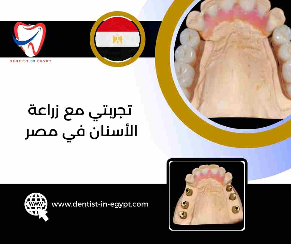 تجربتي مع زراعة الأسنان في مصر