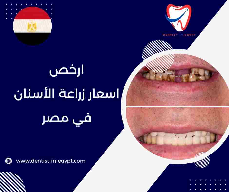 ارخص اسعار زراعة الأسنان في مصر