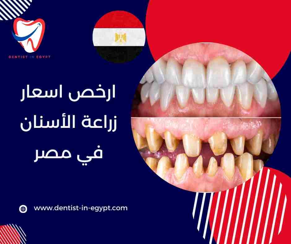 ارخص اسعار زراعة الأسنان في مصر