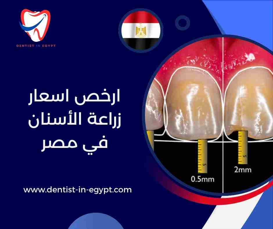 ارخص اسعار زراعة الأسنان في مصر