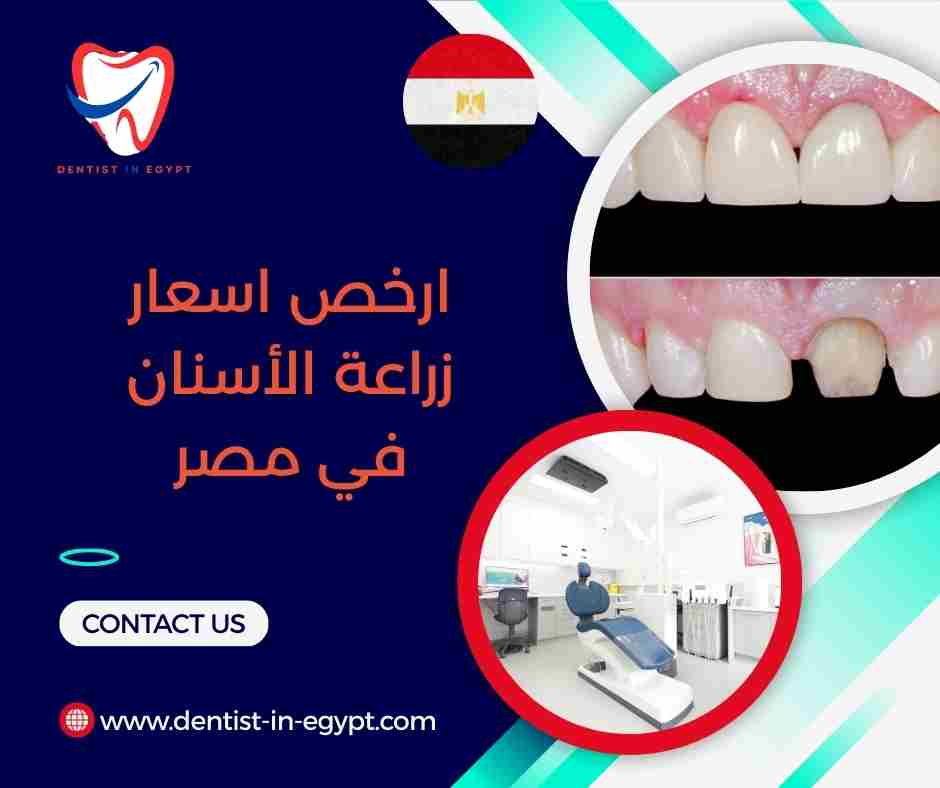 ارخص اسعار زراعة الأسنان في مصر