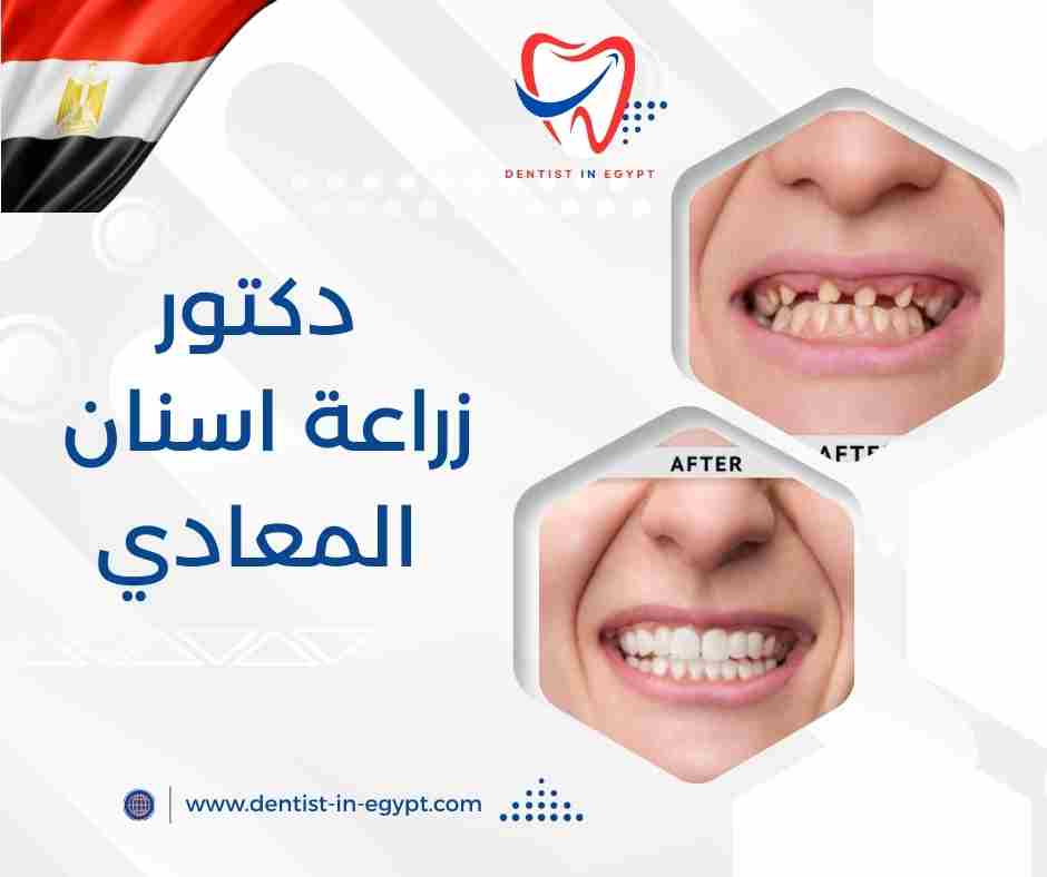 دكتور زراعة اسنان المعادي