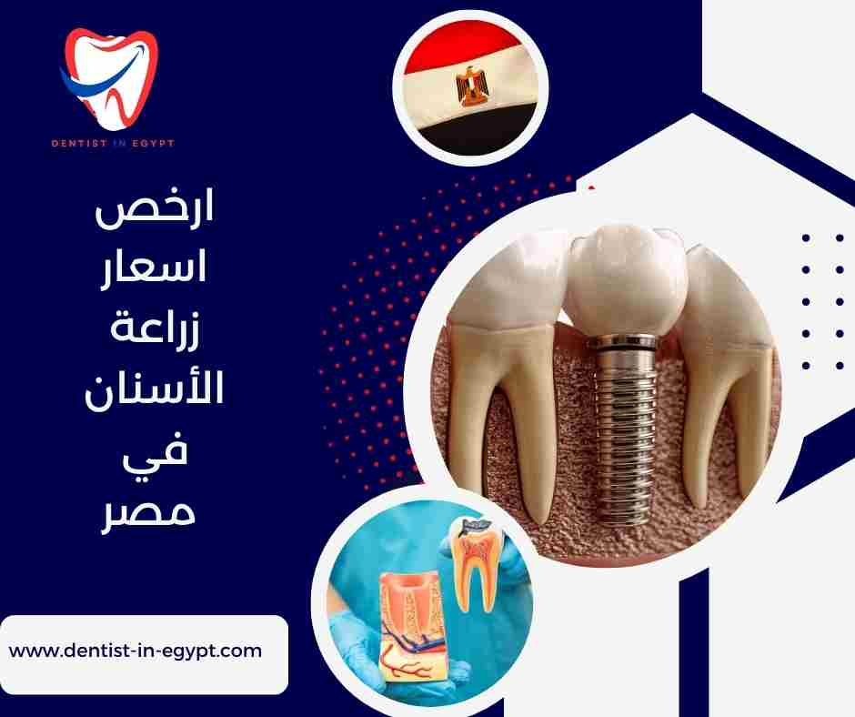 ارخص اسعار زراعة الأسنان في مصر