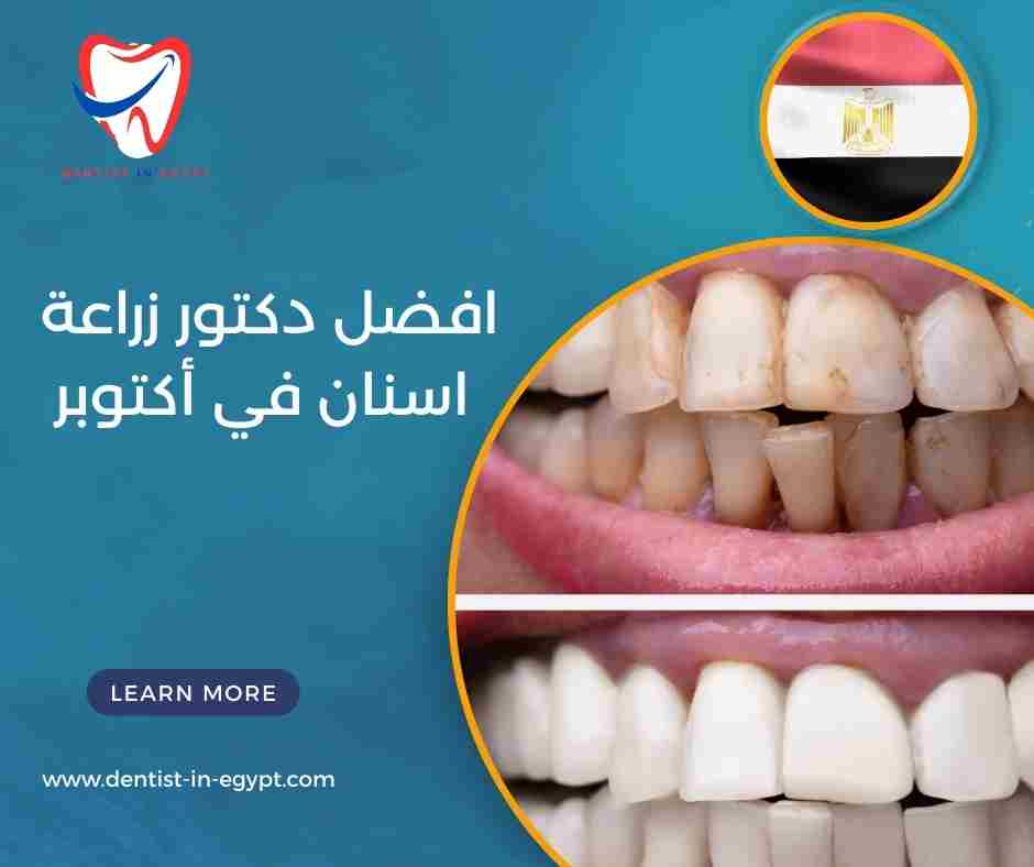 افضل دكتور زراعة اسنان في أكتوبر