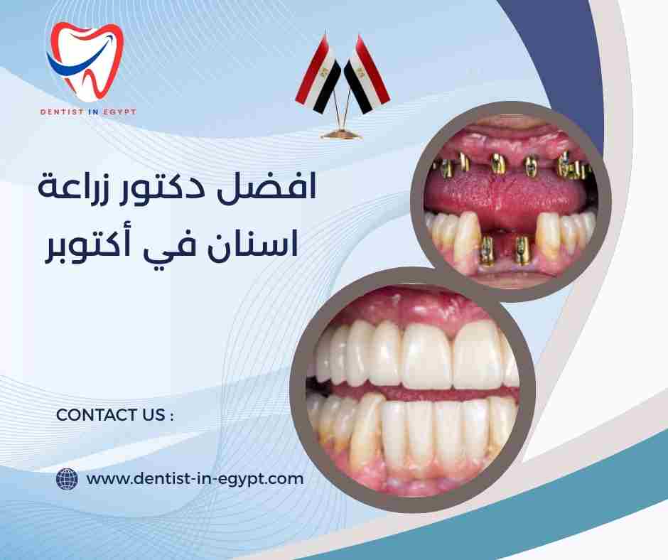 افضل دكتور زراعة اسنان في أكتوبر
