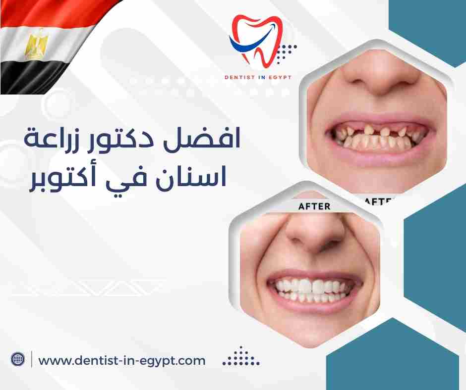 افضل دكتور زراعة اسنان في أكتوبر