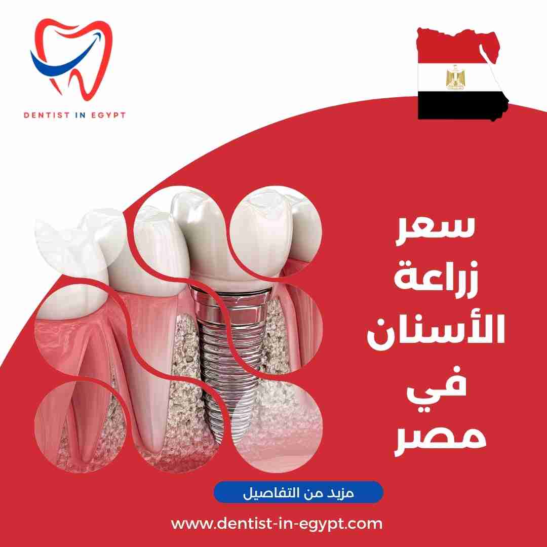 سعر زراعة الأسنان في مصر