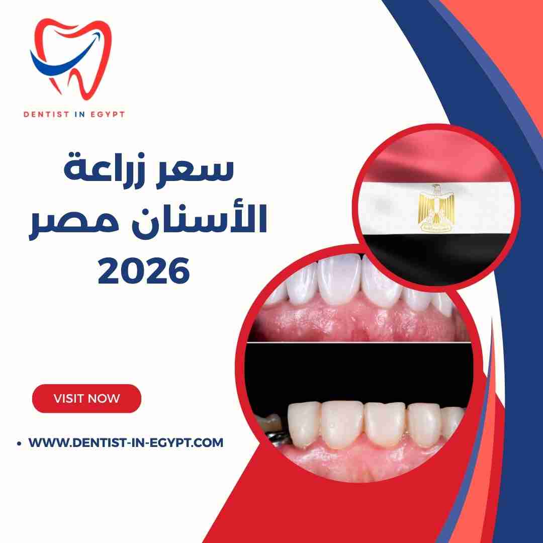 سعر زراعة الأسنان في مصر 2026