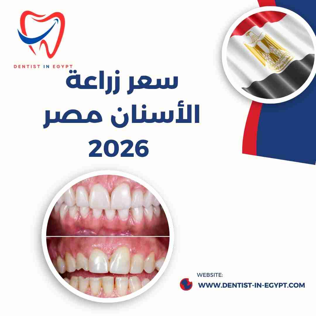 سعر زراعة الأسنان في مصر 2026