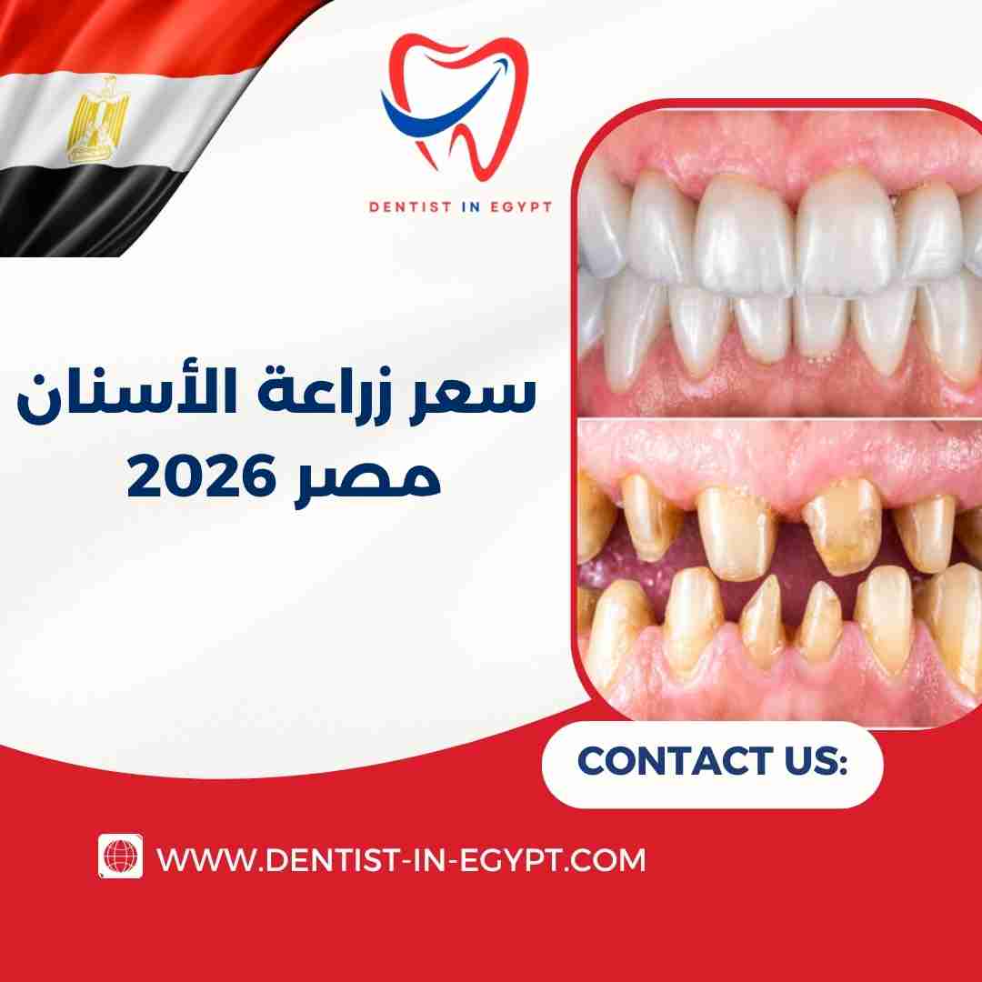 سعر زراعة الأسنان في مصر 2026