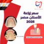 سعر زراعة الأسنان في مصر 2026