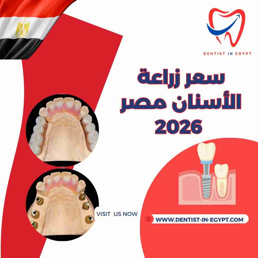 سعر زراعة الأسنان في مصر 2026