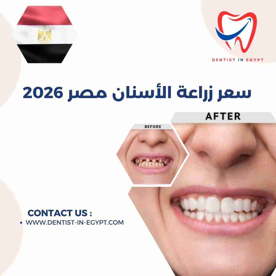 سعر زراعة الأسنان في مصر 2026