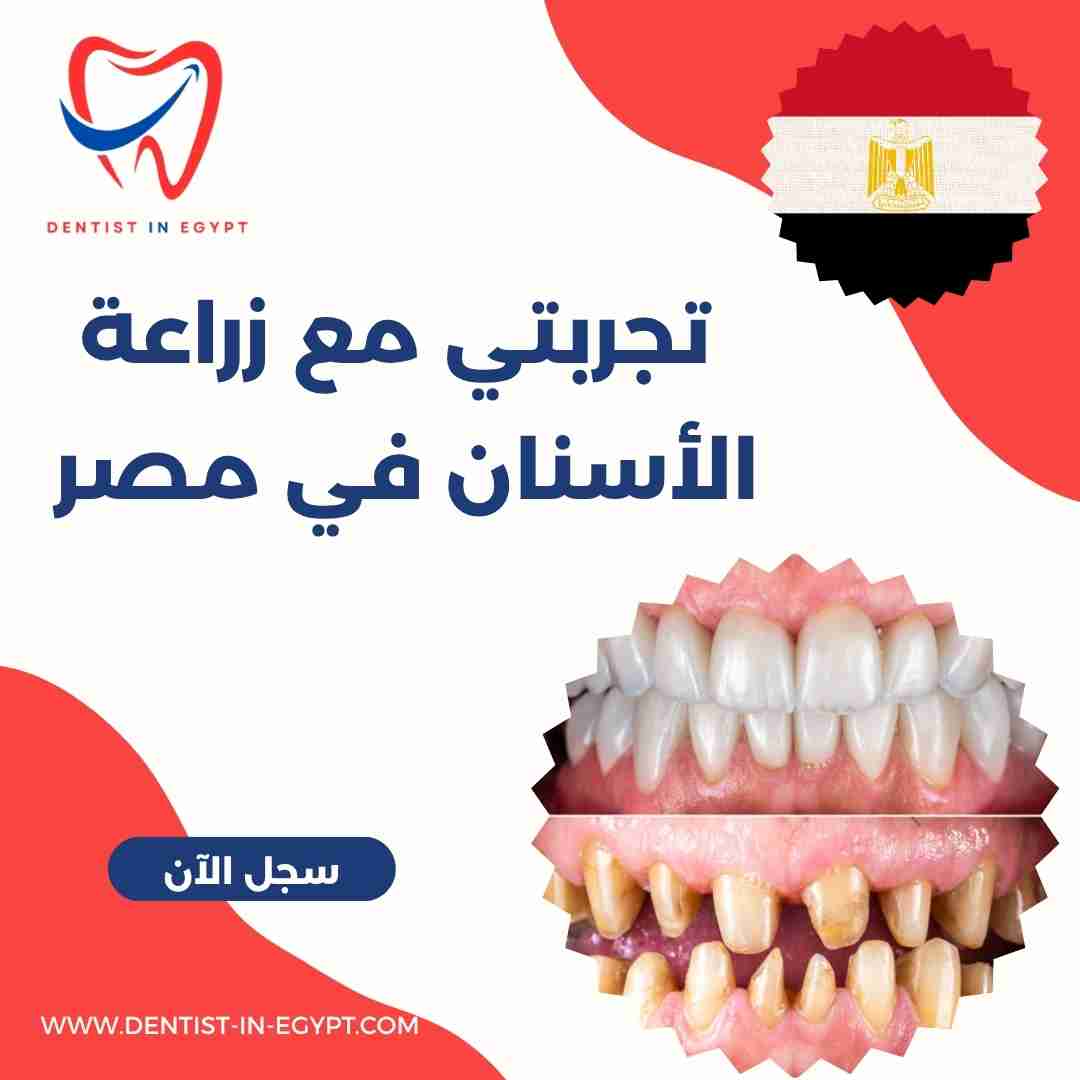 تجربتي مع زراعة الأسنان في مصر