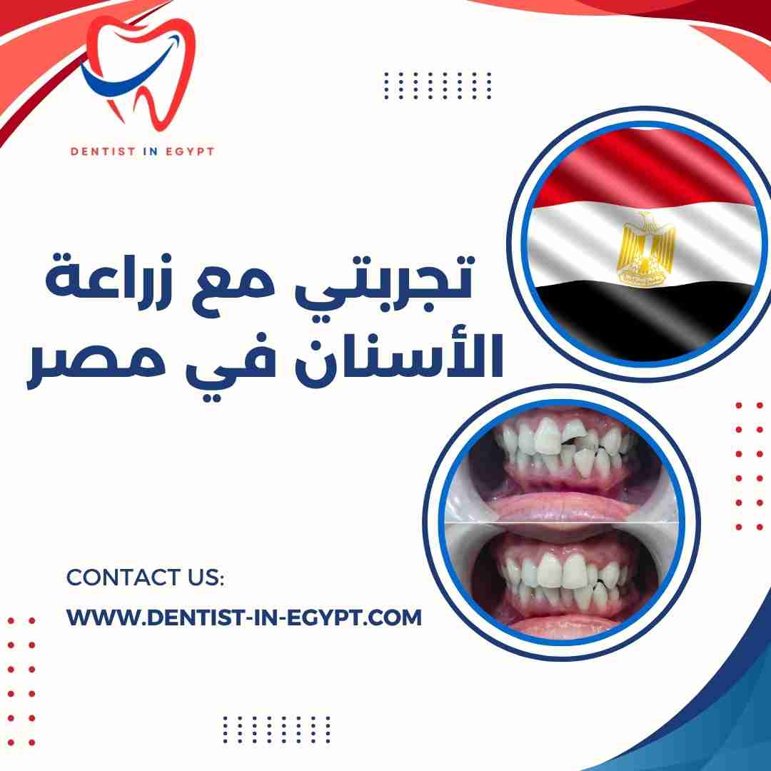 تجربتي مع زراعة الأسنان في مصر