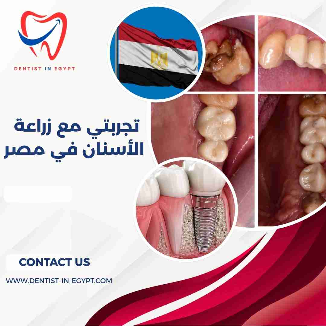 تجربتي مع زراعة الأسنان في مصر