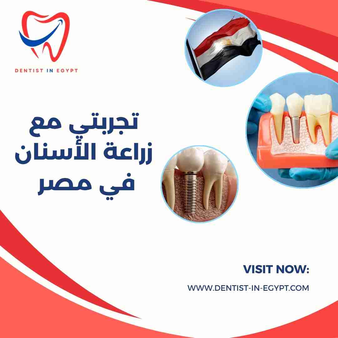 تجربتي مع زراعة الأسنان في مصر