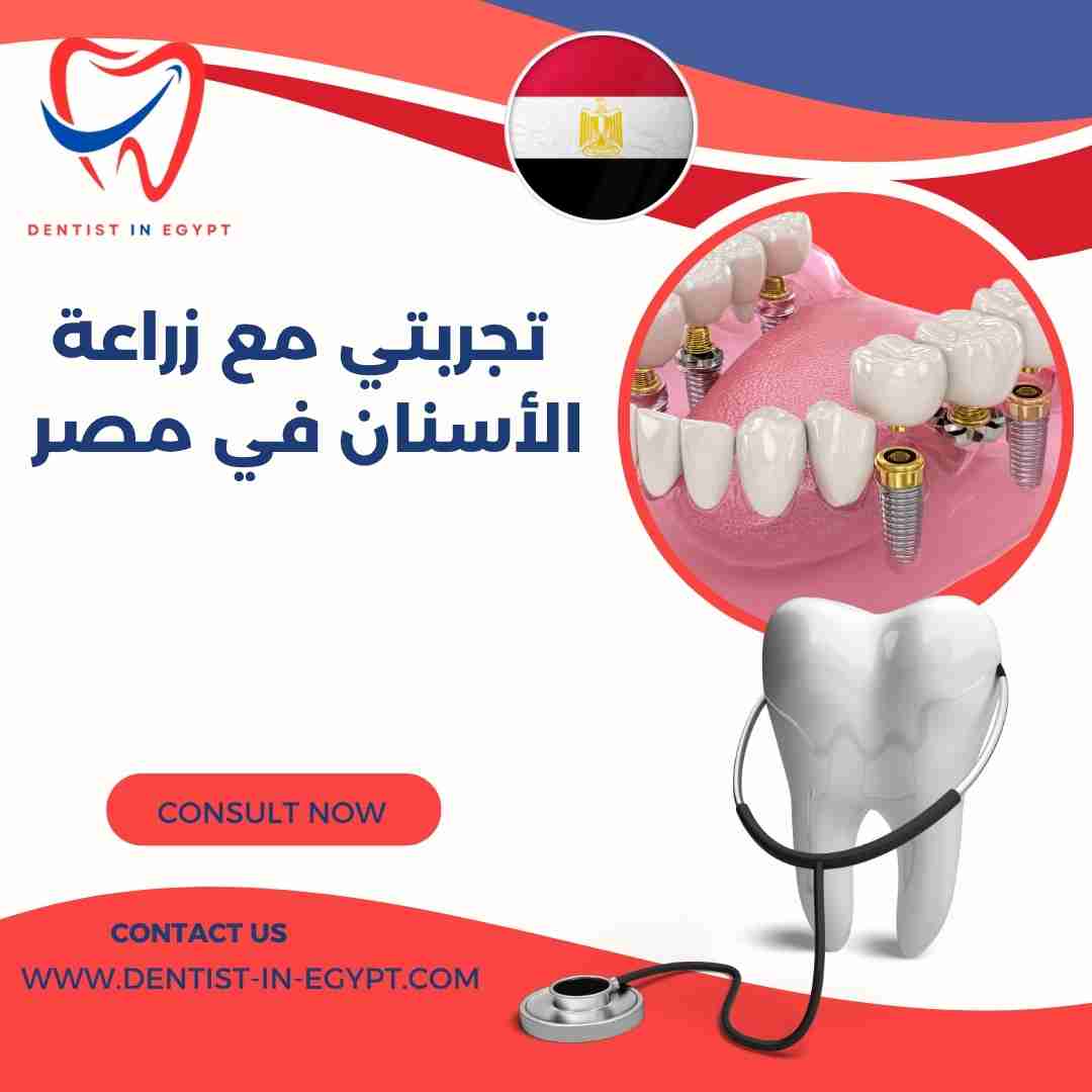 تجربتي مع زراعة الأسنان في مصر