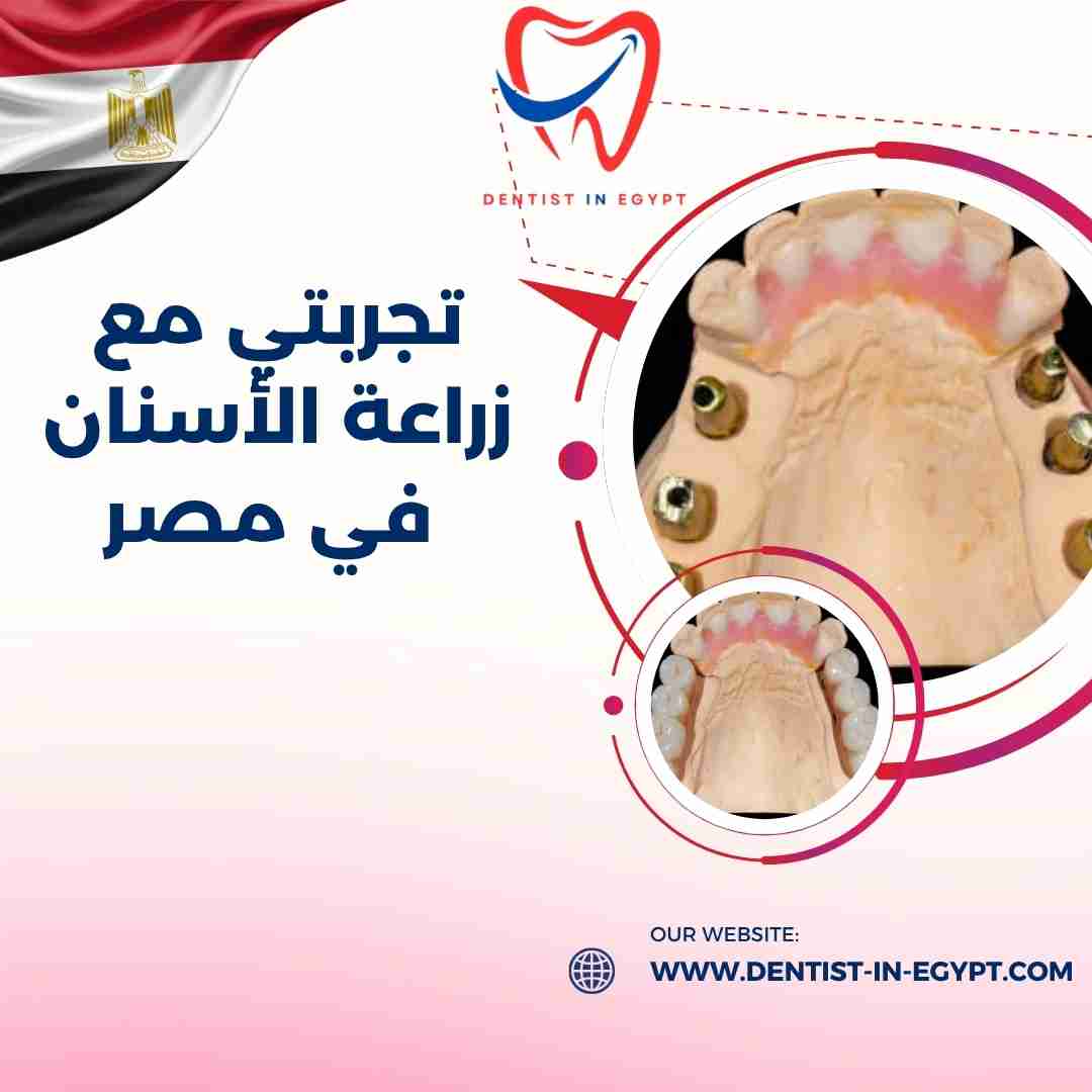 تجربتي مع زراعة الأسنان في مصر
