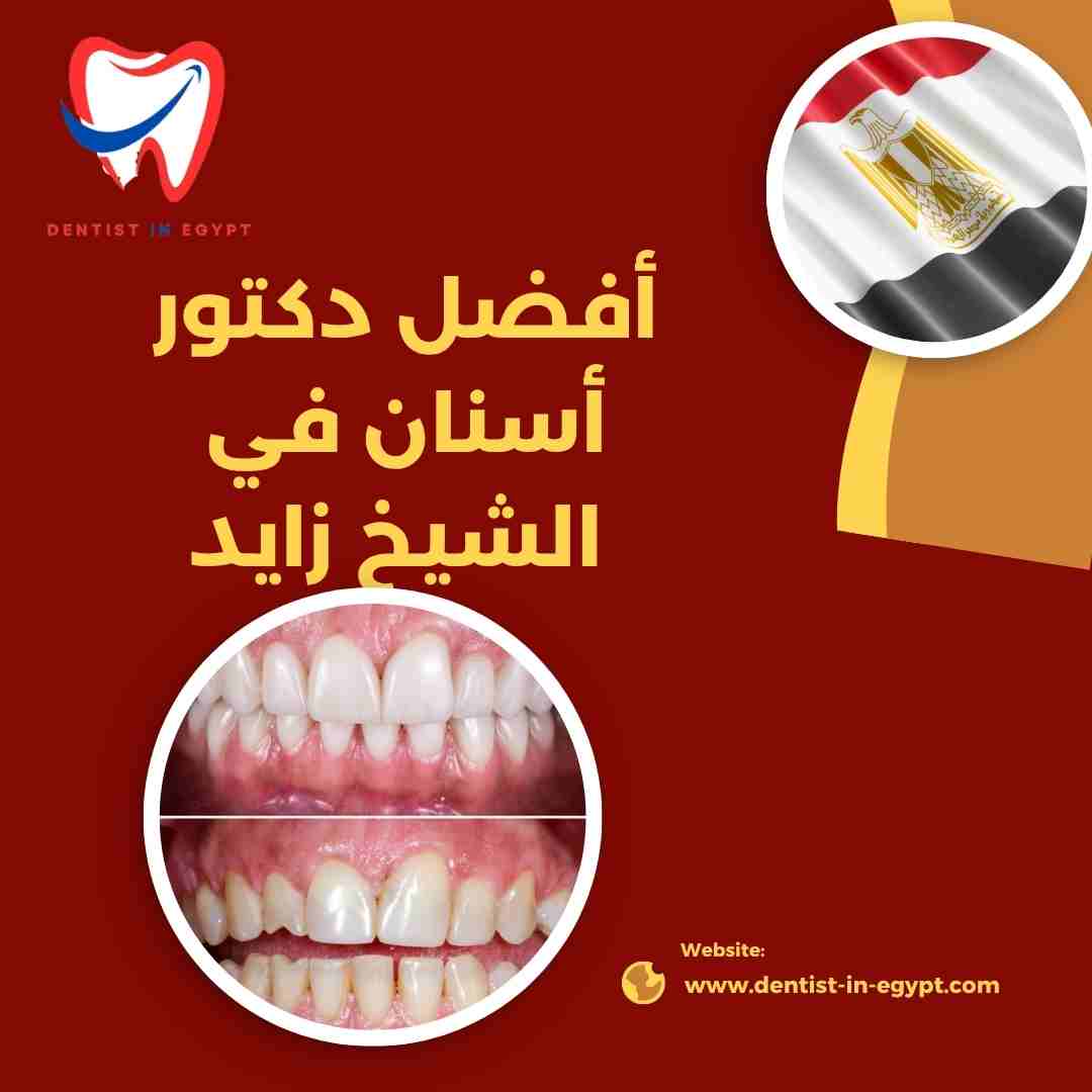 أفضل دكتور زراعة أسنان في الشيخ زايد