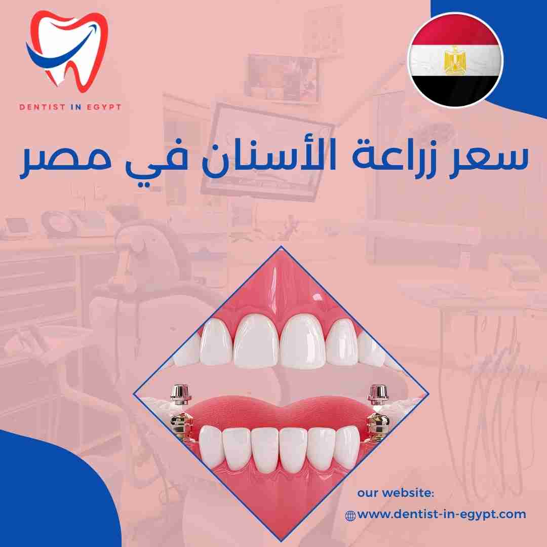 سعر زراعة الأسنان في مصر