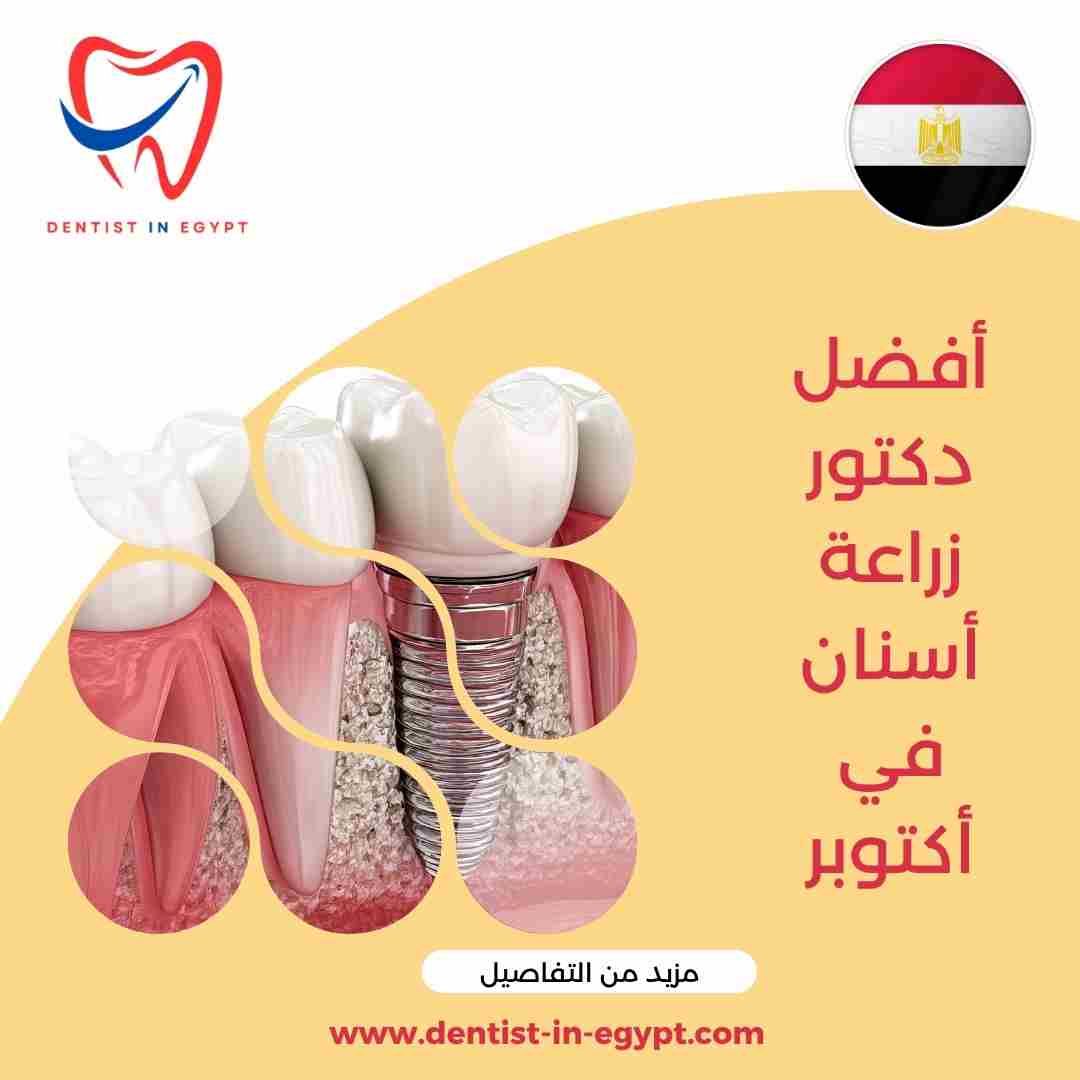 أفضل دكتور زراعة أسنان في أكتوبر