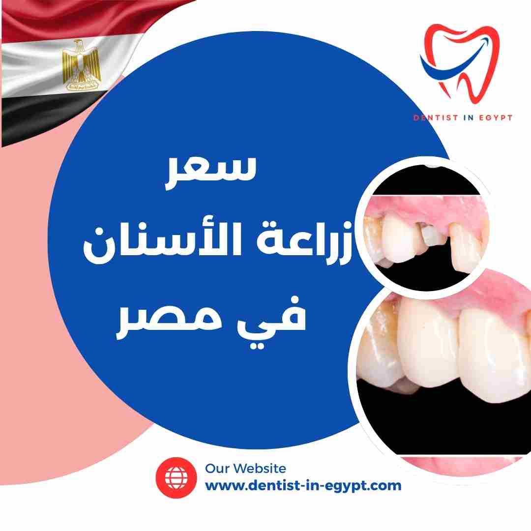 سعر زراعة الأسنان في مصر