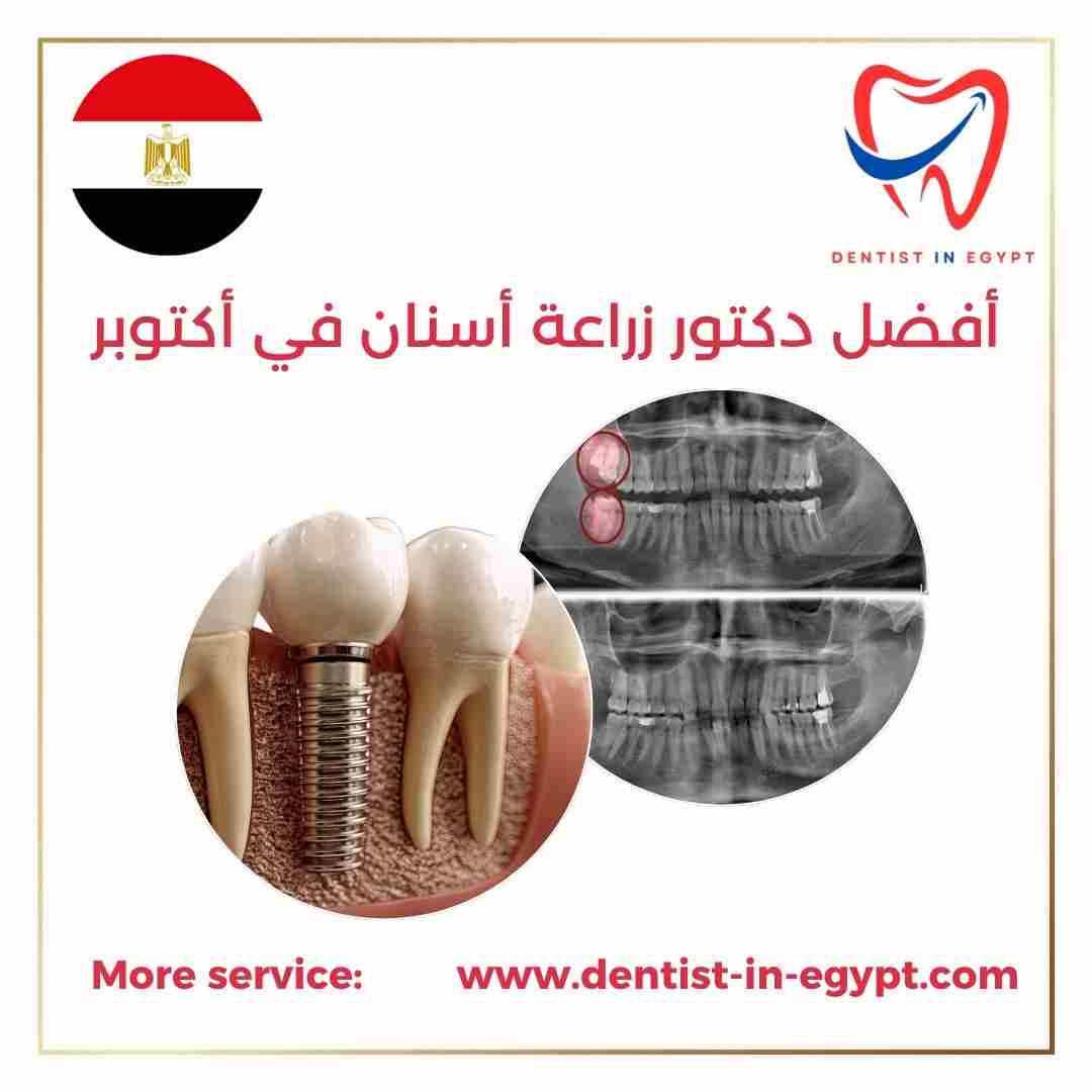 أفضل دكتور زراعة أسنان في أكتوبر