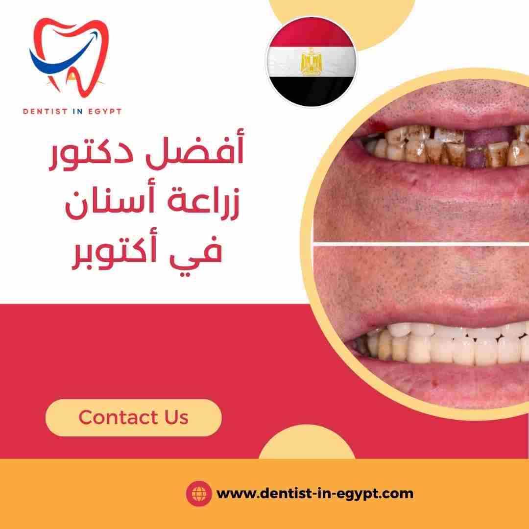 أفضل دكتور زراعة أسنان في أكتوبر