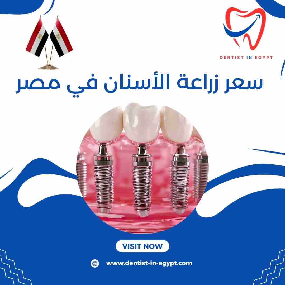 سعر زراعة الأسنان في مصر
