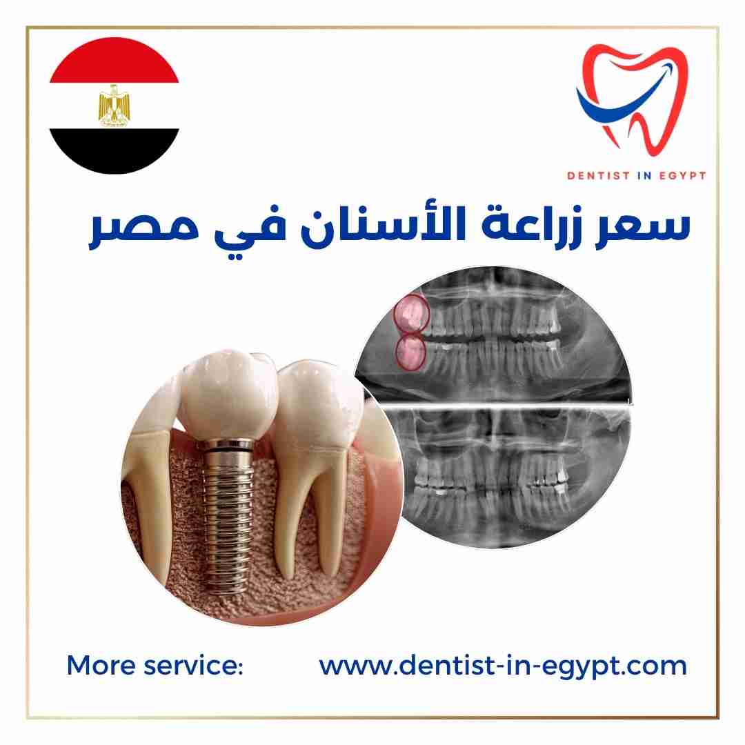سعر زراعة الأسنان في مصر
