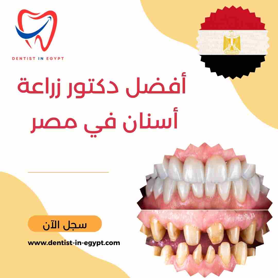 أفضل دكتور زراعة أسنان في مصر