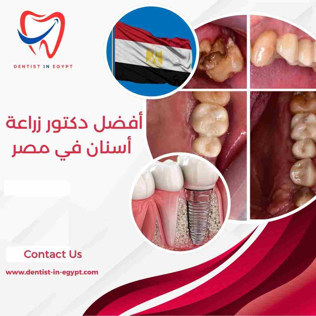أفضل دكتور زراعة أسنان في مصر