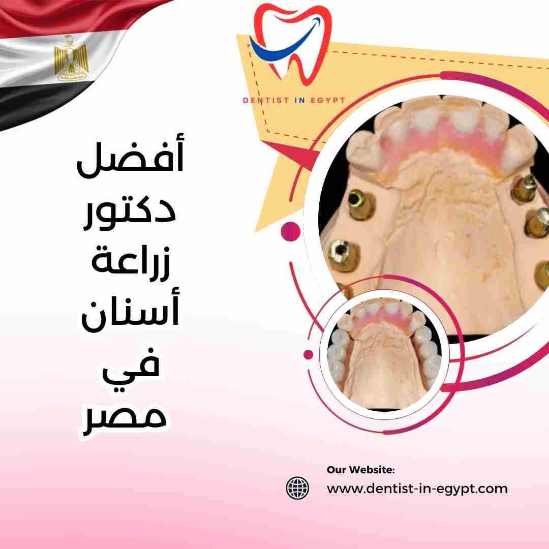 أفضل دكتور زراعة أسنان في مصر