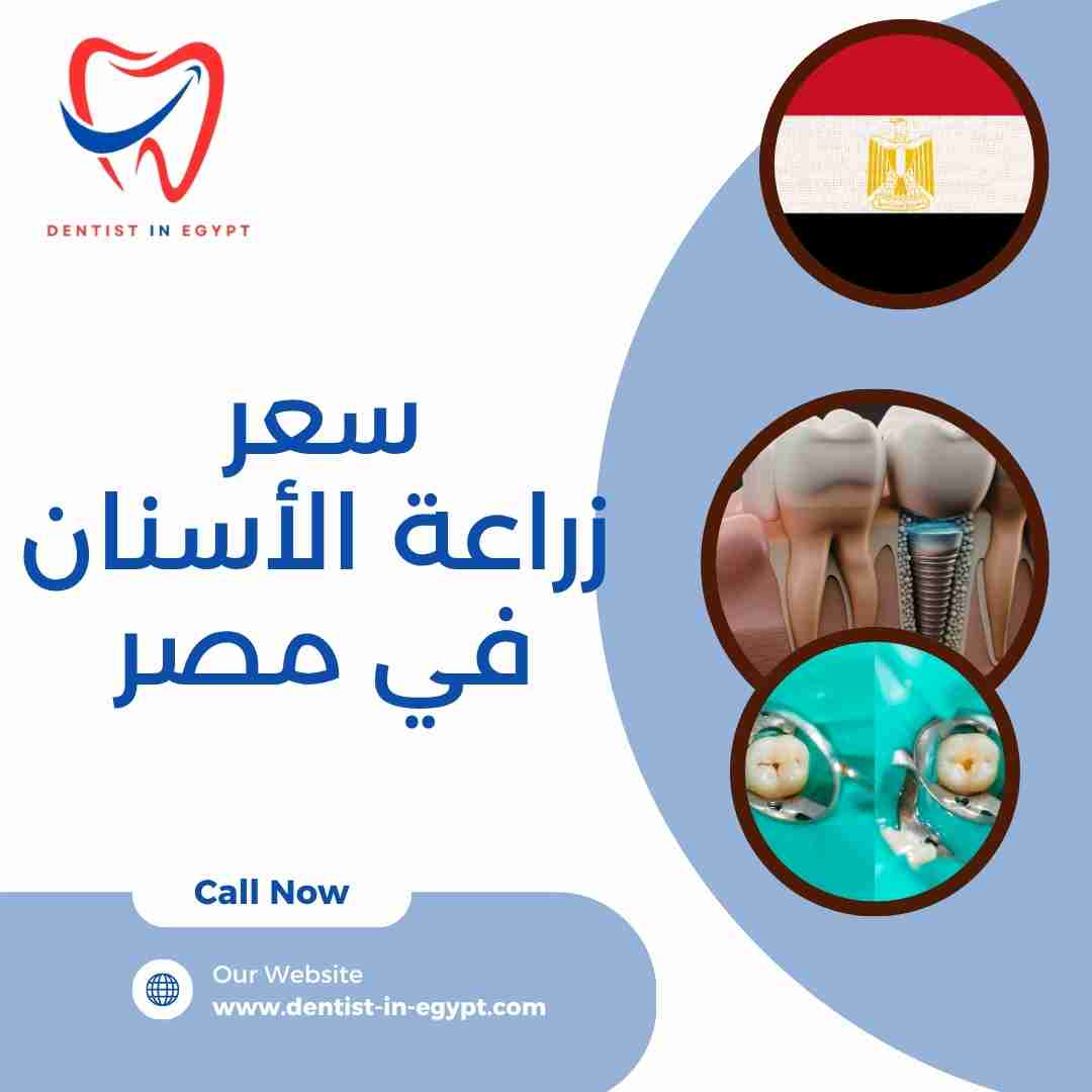 سعر زراعة الأسنان في مصر