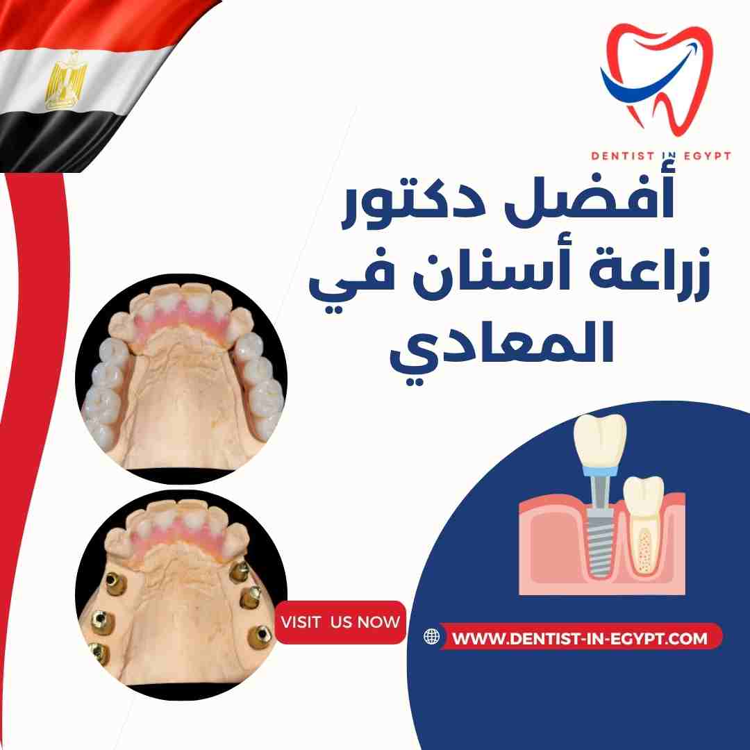 أفضل دكتور زراعة أسنان في المعادي