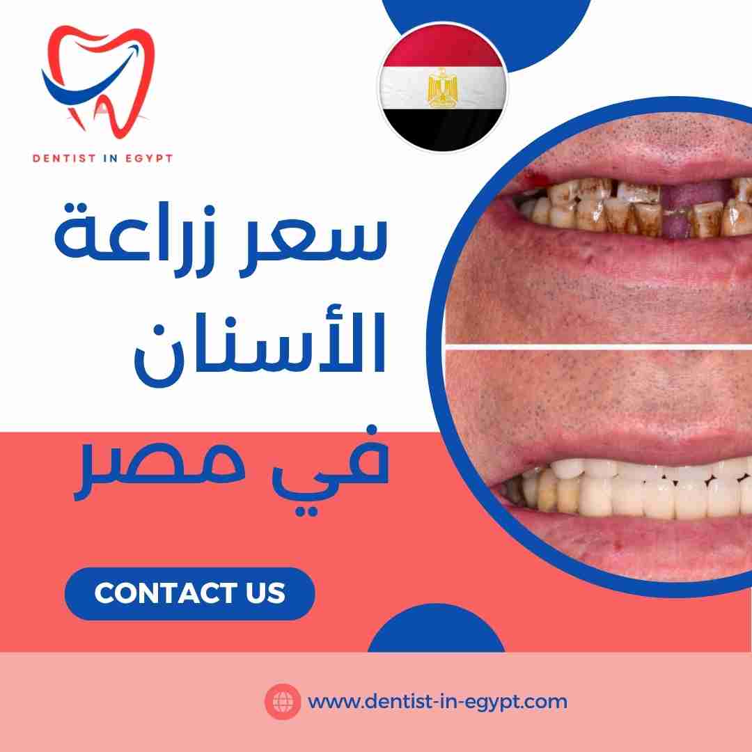 سعر زراعة الأسنان في مصر
