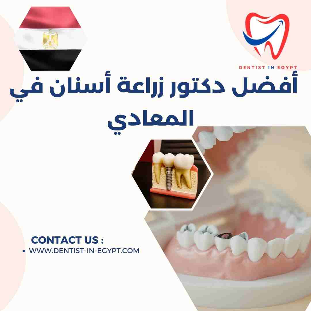 أفضل دكتور زراعة أسنان في المعادي